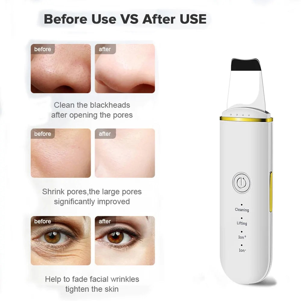 Beauty Ultrasonic Skin Scrubber Beauty Ultrasonic Skin Scrubber